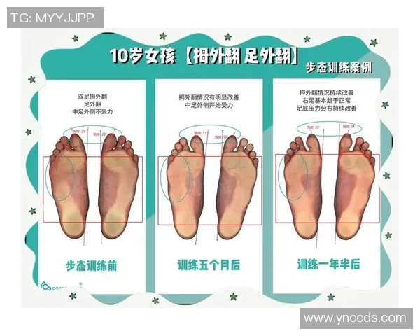 拇外翻困扰足球明星的职业生涯与健康管理探讨